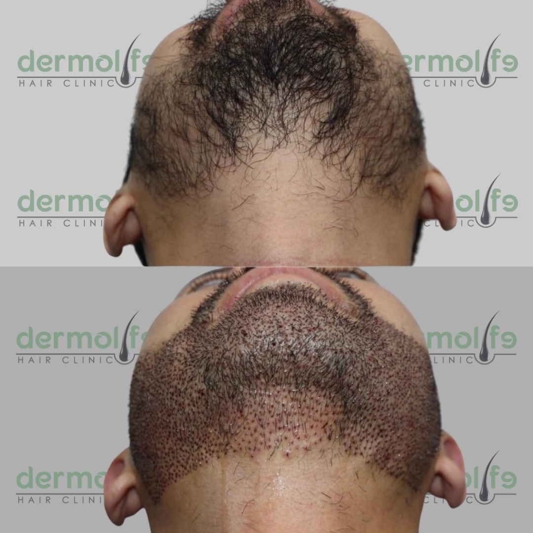 Mbjellja e mjekres ne Shqiperi